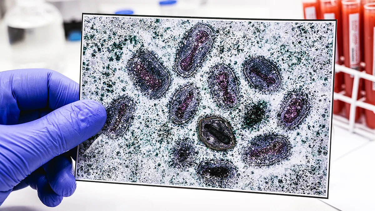 Connecticut confirms first clade I mpox case linked to travel in Europe